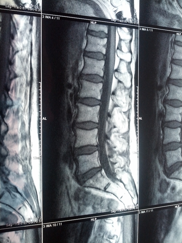 Röntgen-Aufnahmen der unteren Wirbelsäule - ein MRT wäre besser gewesen