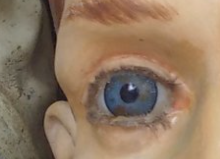 Augenoperation wegen grauem Star
