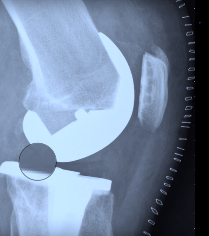 Behandlung bei Entzündung bei Knieprothese - wie muss der Arzt aufklären?
